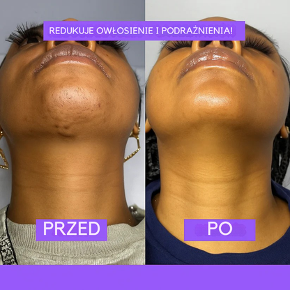 Fiorea – redukuje owłosienie od nasady (Cyperus Rotundus)